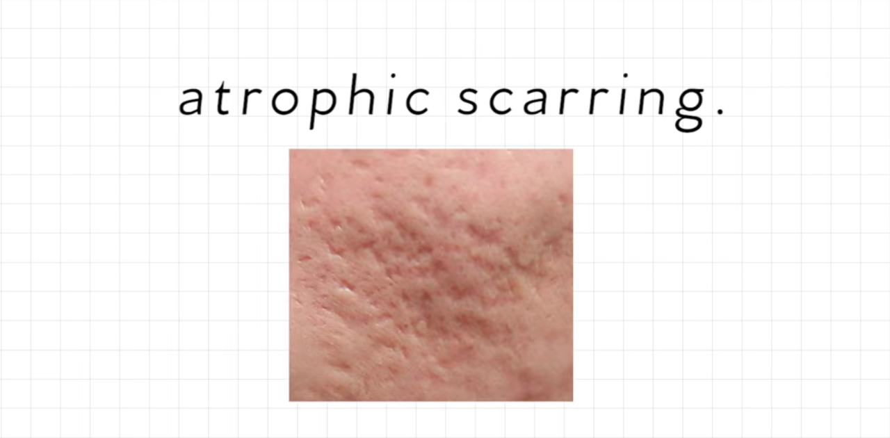 atrophic scar